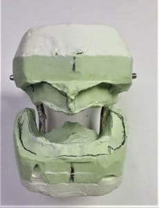 שיניים תותבות - מינשך לתכנון