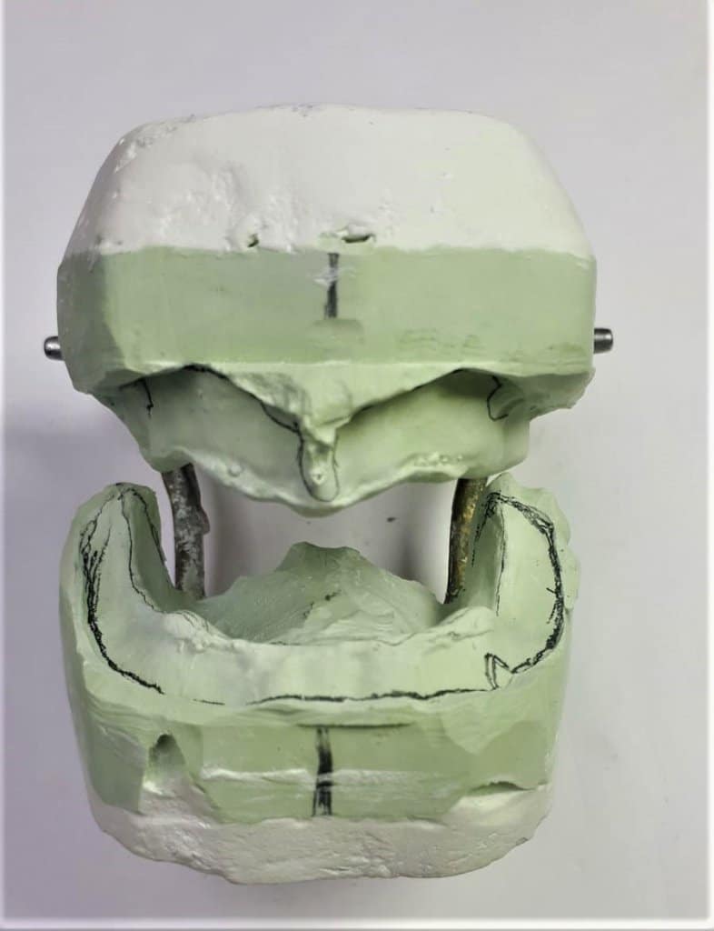 שיניים תותבות - מינשך לתכנון