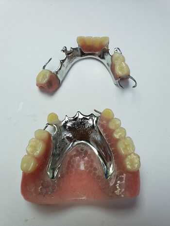 שיניים תותבות חלקיות קבועות