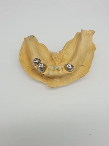 יסקין - טכנאי שיניים - תיקון שיניים תותבות