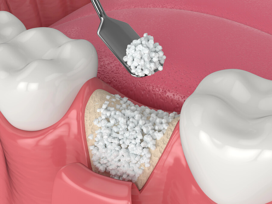 השתלת עצם למחוסרי עצם